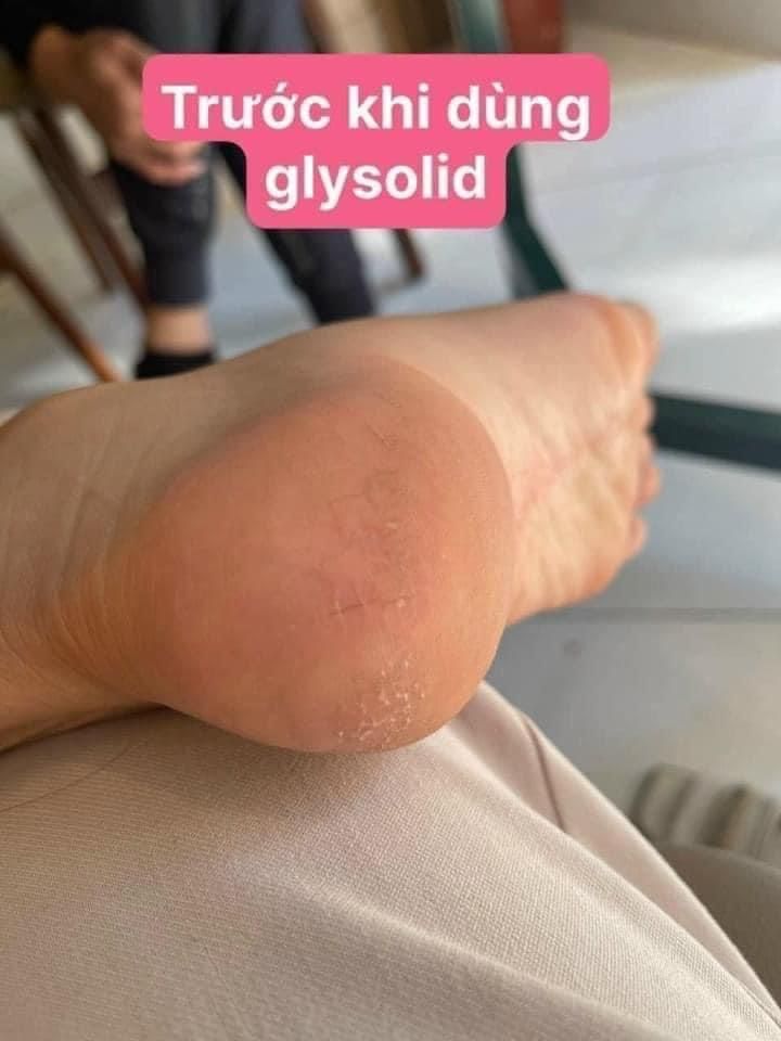 KEM NẺ Glysolid Hautbalsam